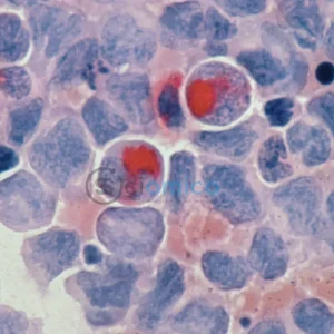 AI Discovers Five Hidden Cancer Cell Types to Prevent Tumor Recurrence 14