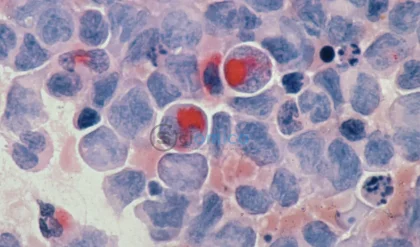AI Discovers Five Hidden Cancer Cell Types to Prevent Tumor Recurrence 3