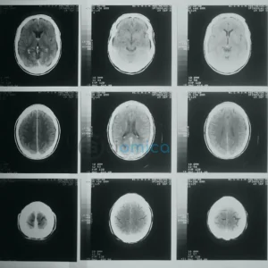 CT Scans Uncover Hidden Heart Risks: How AI is Revolutionizing Diagnosis 18