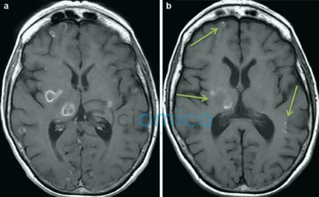 Toxoplasmosis is particularly dangerous for immunocompromised patients. The above images show T. gondii lesions in the brain of a patient with AIDS. (Ambrosioni et al., Encyclopedia of AIDS)